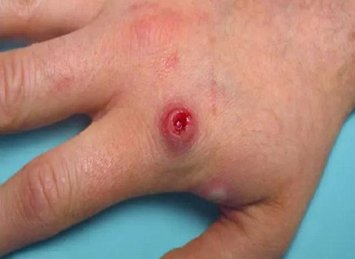 درک Monkeypox و نحوه جلوگیری از آن